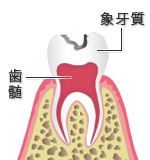 Ｃ２：象牙質の虫歯