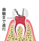 Ｃ３：歯の神経（歯髄）の虫歯