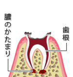 Ｃ４：末期の虫歯