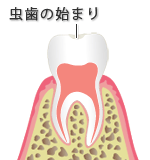ＣＯ：初期虫歯